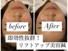 美容鍼《小顔/たるみ改善/眼精疲労/ほうれい線/首凝り》　11000円→8800円 
