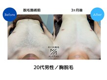 メンズアメリ/高知/メンズ脱毛/ヒゲ/全身/VIO