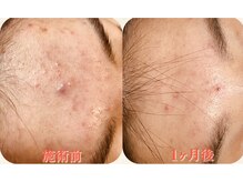 クイーン(QUEEN)/光フォトのビフォーアフター