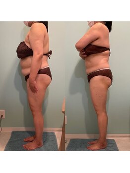 ローズハニー 小田原店/痩身モニター様比較写真