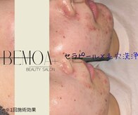 ビモアプラス(BEMOA+)