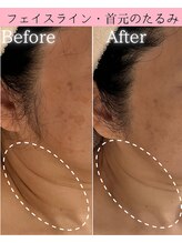 ココロ(COCORO)/フェイスライン、首元のたるみも