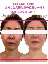 アファン 鶴見店(Afun)/【30代小顔】たるみスッキリ◎