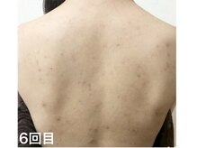 ピリナ 名古屋/背中ニキビケア