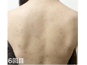 ピリナ 名古屋/背中ニキビケア