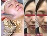 【脂肪分解/たるみ/クマ】進化版レモンボトル×即効小顔フェイシャル