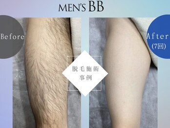 メンズBB 福井高柳店(MEN'S BB)/ボディ脱毛施術事例