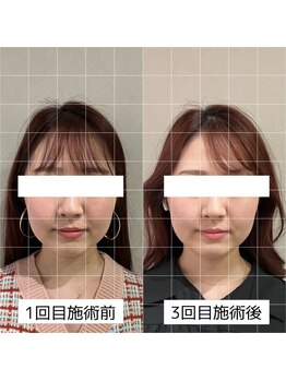 ヴィーライン 大阪梅田院(VeLine)/鍼灸／美容鍼／小顔／大阪／梅田