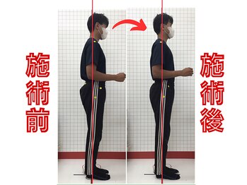 ほねつぎ須屋鍼灸接骨院/反り腰・猫背矯正