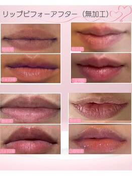 ローマサロン/韓国で話題♪最先端の黒ずみ除去