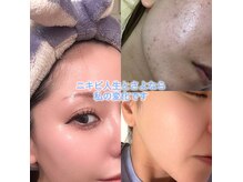 スタッフAkiのbefore after♪