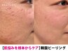 夏でも出来る★【シミシワニキビ!!肌改善】　セルマン韓国ピーリング¥11,000