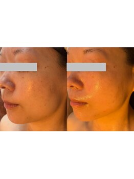 リベルタ/Wリフトフェイシャル