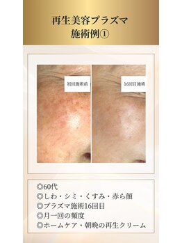 イデアーレ(ideale)/60代・プラズマ16回目の効果