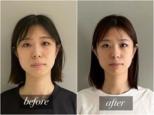 施術7回目の変化/顔の長さを短くする小顔矯正、中顔面短縮