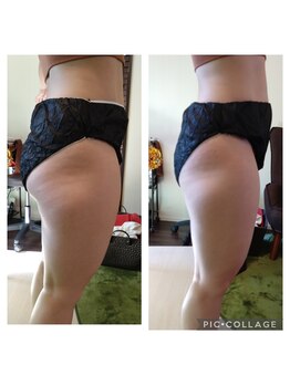 フロレゾン(Floraison)/結果No.1 脂肪分解ケア