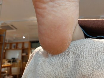 爪切り屋 足楽/４０代女性◆踵の「ふち」のタコ