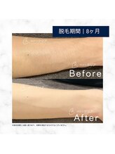 メンズクリア 浜松店/【メンズクリア】お客様の施術例