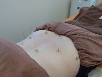 美藤鍼灸院の写真/“美容鍼”でリフトアップ＆肌質改善を叶える鍼灸院♪美肌の速攻性と持続性の効果にこだわり◎