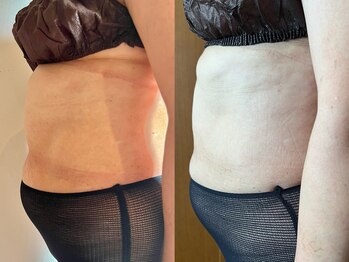 マロカ(Marroka)/50代。4回の施術でこの効果!