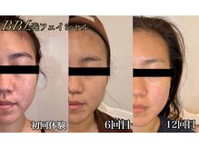 ラブ美長寿 沖縄本店(Lab)/BBLフィシャルの肌質改善