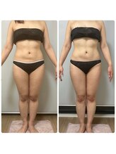 ジェニー(JENNI)/痩身+ヒートマット　施術４回