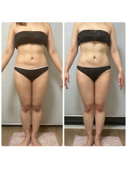 ジェニー(JENNI)/痩身+ヒートマット　施術４回