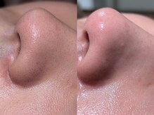 モルフォム(Morphome)/毛穴洗浄