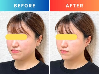 シールド バイ ココイロ(SHIELD by COCOIRO)/小顔矯正　B＆A