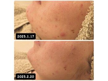 カルア(CALUA)/【ニキビケア】ハーブピーリング