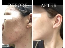 ヨサパーク アーバンヘブン 目黒(YOSA PARK Urban Heaven)/肌荒れ知らずの美肌が叶う！