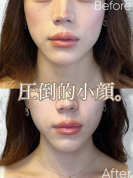 ルミライ(Lumirai)/たるみ改善|毛穴|フェイシャル