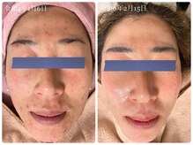 剥離なしハーブピーリング☆日本製の厳選されたハーブを使用♪