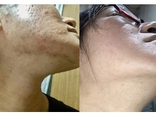 ヨサパーク ラリマー(YOSA PARK Larimar)/美肌叶う水素洗顔