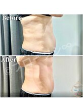 フローフシ∞/【お腹】60代女性症例写真