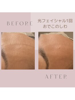スリール 吉祥寺店(Sourire)/おでこのシワ悩む