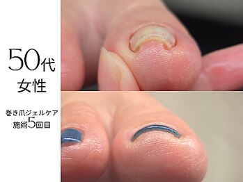 フットケア クラッシー(footcare classy)/ジェルで巻き爪ケア♪
