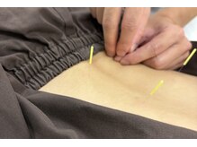 七草はり灸マッサージ院の雰囲気(細めの鍼を使用しています。細くてもしっかりと効果を感じます。)