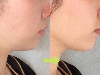 ソワン/フェイシャル/小顔/リフトアップ