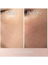 ステラティエ(Stellatier)/シミ/シワ/たるみ/リフトアップ