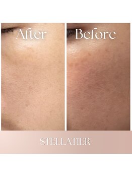 ステラティエ(Stellatier)/シミ/シワ/たるみ/リフトアップ