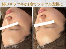 ぷるる 練馬 江古田/20代　ララピール＋ゲルマスク