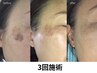 韓国発！はがすシミケア　2箇所　WHITELAB