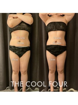 クライオ360(Cryo360)/脂肪冷却ビフォーアフター