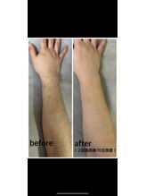 エクシア(excia)/メンズ腕脱毛