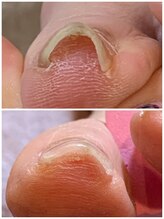 リネイル 長浜(Re-na-iL)/ネイルケア＆スパ¥7000