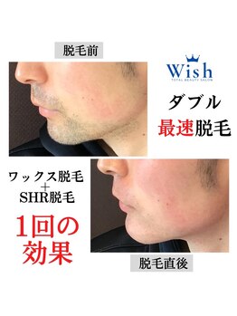 メンズ脱毛 ウィッシュ(Wish)/ダブル脱毛　ワックス×SHR脱毛