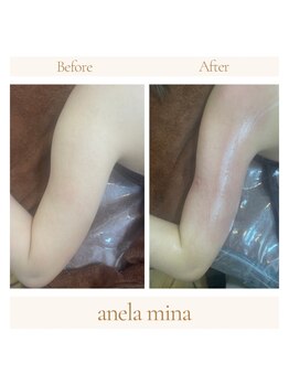 アーネラミーナ(Anela mina)/施術例