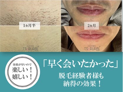 みんなの脱毛 ツルリン(TSURURIN)の写真