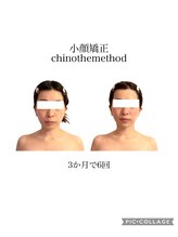 トゥルプ(TULIP)/嬉野市小顔矯正